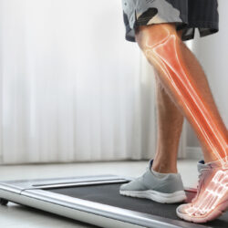 Como manter a saúde dos ossos